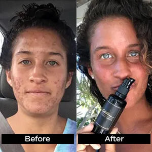 Before and After of Woman holding Alitura Gold Serum, with severe acne on the before and clean brightened skin on the after