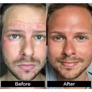 before and after photo of a young man experiencing severe rosacea on the before, and clear beautiful skin for the after