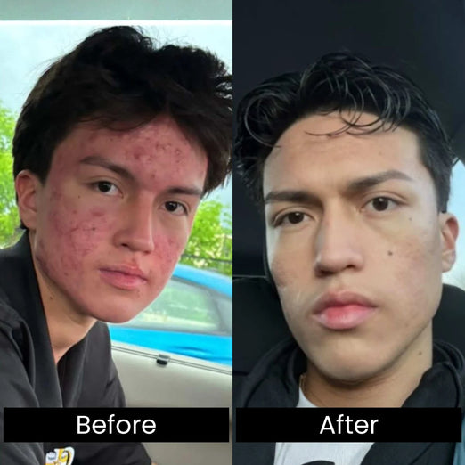Before and after comparison of a person with acne on their face.