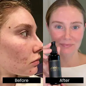 Before and after comparison of a person's face with a skincare product shown.