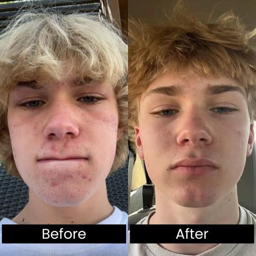 Teen Before and After
