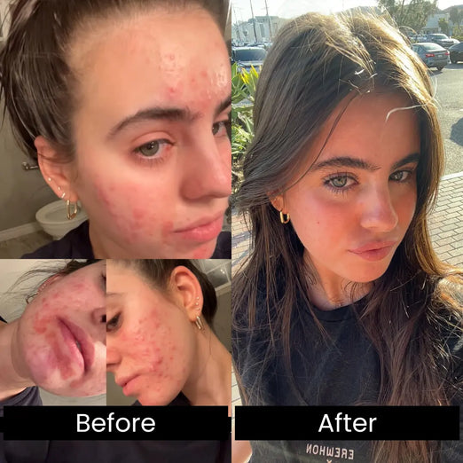before and after photo of a young woman experiencing severe acne on the before, and clear beautiful skin for the after