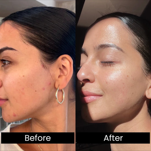 zoe before after
